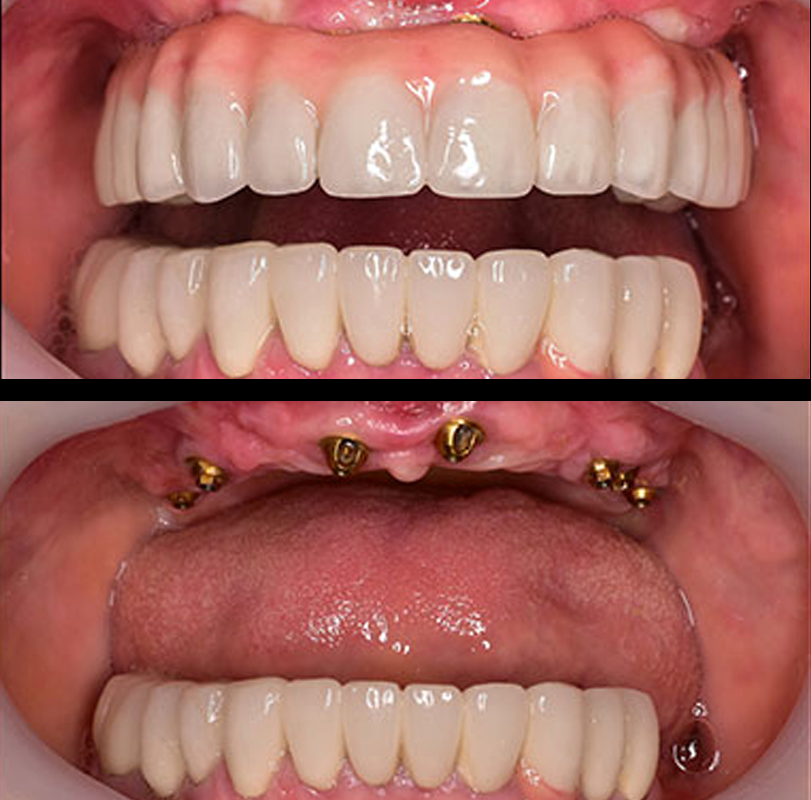 resultados-sorriso-1