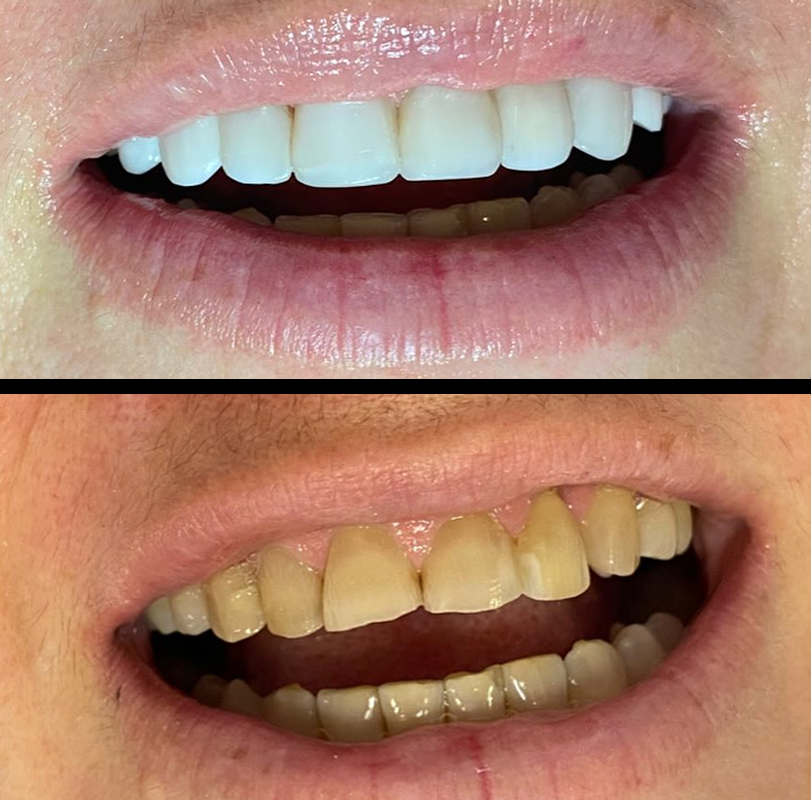 resultados-sorriso-2