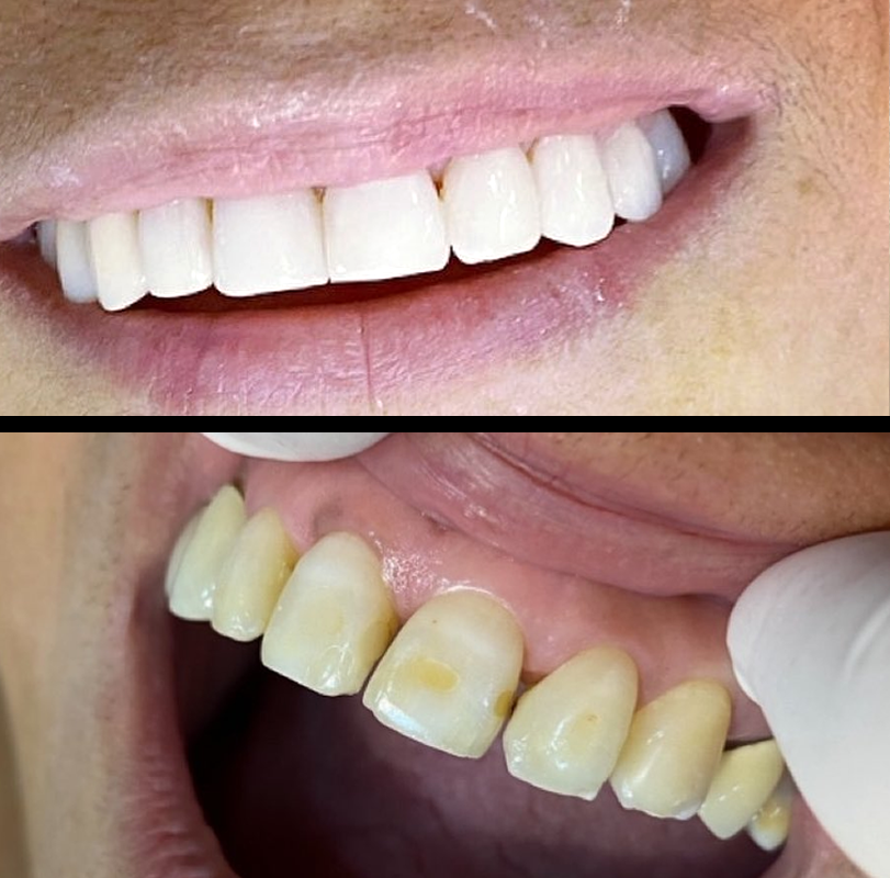 resultados-sorriso-3