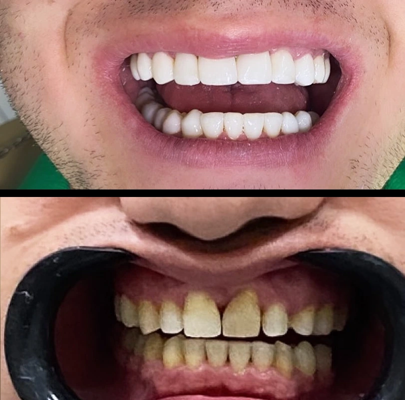 resultados-sorriso-4