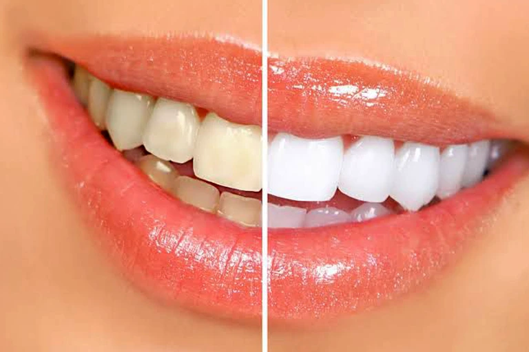 Clareamento Dental