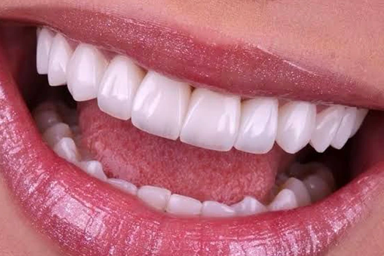 Facetas Resina/Porcelana